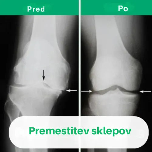 OrthoKnee™ – Dolgotrajno olajšanje artritisa in bolečin v sklepih
