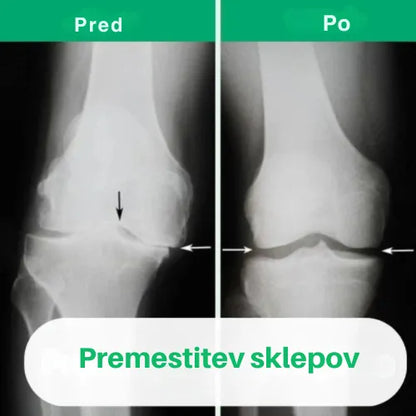 OrthoKnee™ – Dolgotrajno olajšanje artritisa in bolečin v sklepih